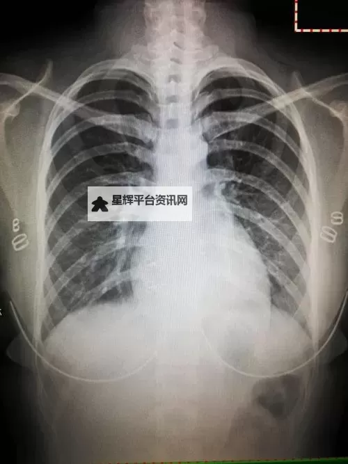 2023年最新资讯：胸片曝光没有衣服事件全解析图1