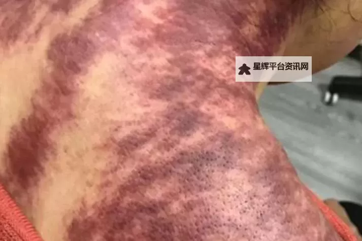 紫黑色肿大横冲直撞:暗影中的恐怖变异揭秘图1