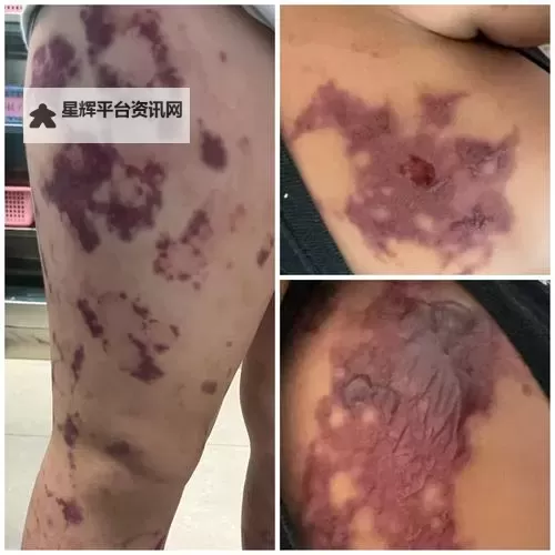 紫黑蘑菇横冲直撞引发红肿JH的神秘事件图1