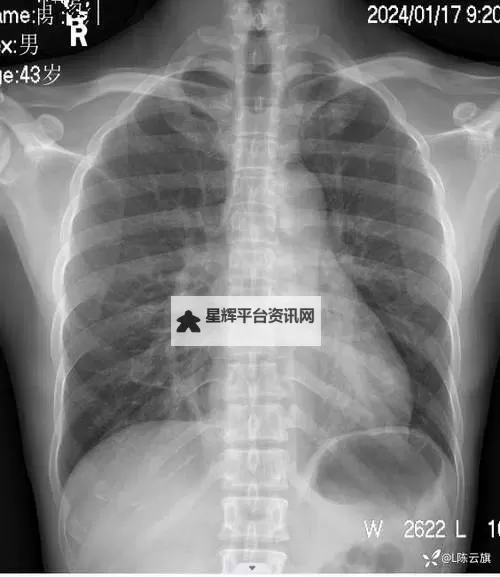 最新曝光：免费的胸片曝光2025年已更新，全面解析未来趋势图1