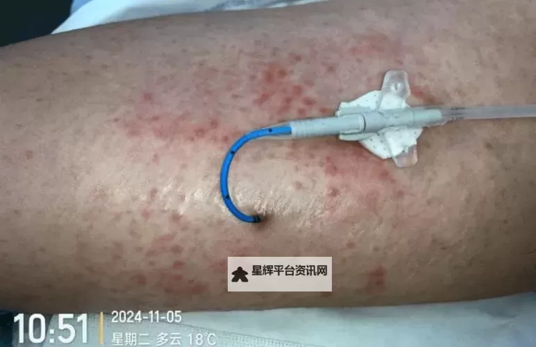 注射器打水后放皮炎事件曝光,处罚措施引关注——最新视频网站报道图1